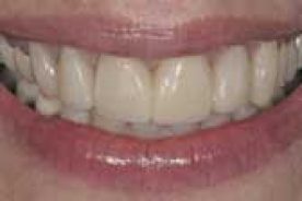9b40cb34-dae3-11e1-bd8c-1231394043be-gaila_teethafter